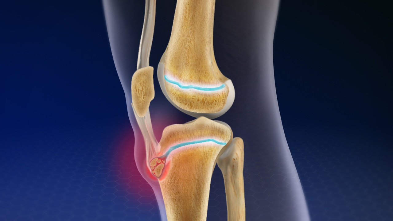 Диагностика причины боли и шишки на колене