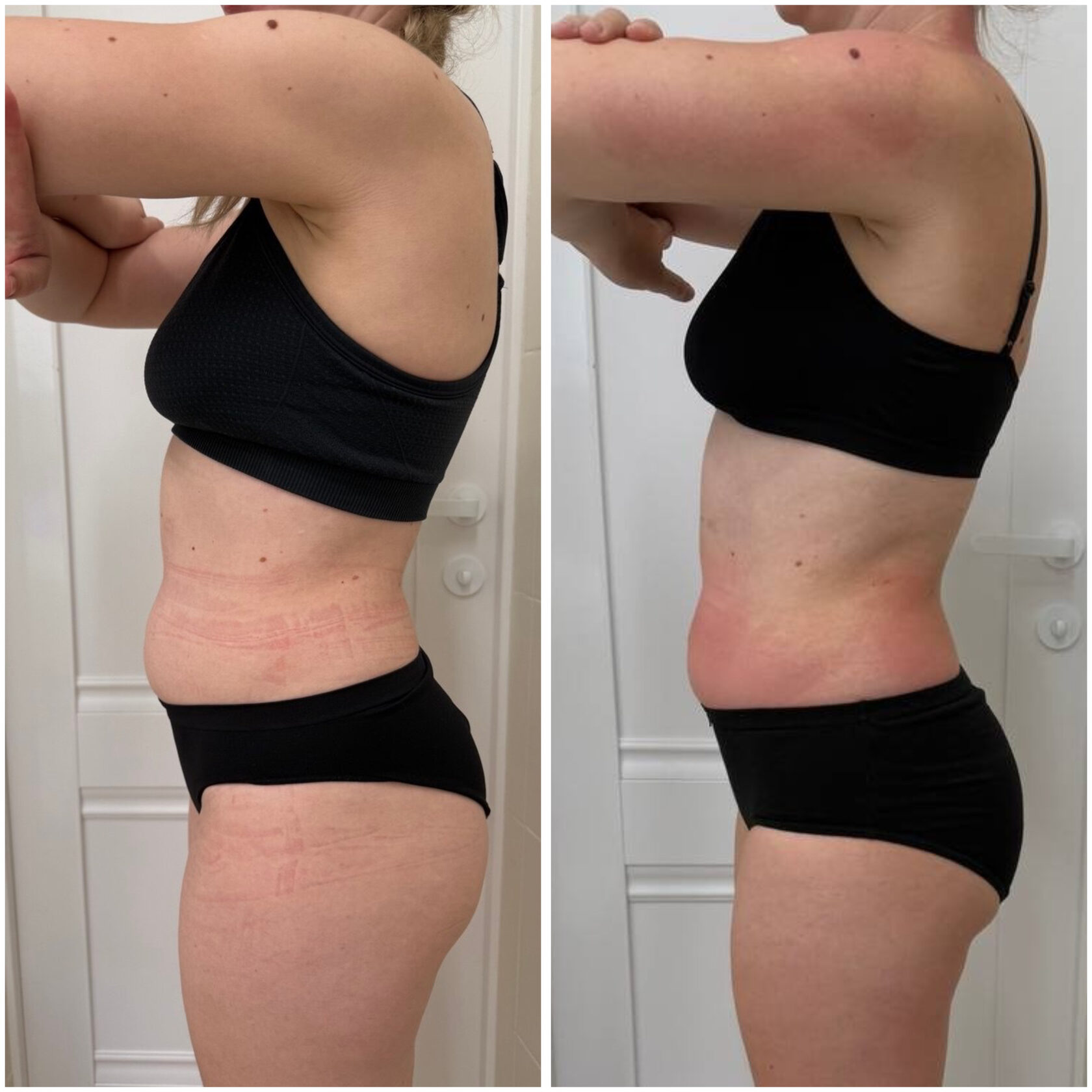 Коррекция фигуры на корейском аппарате Циклосфера PRO