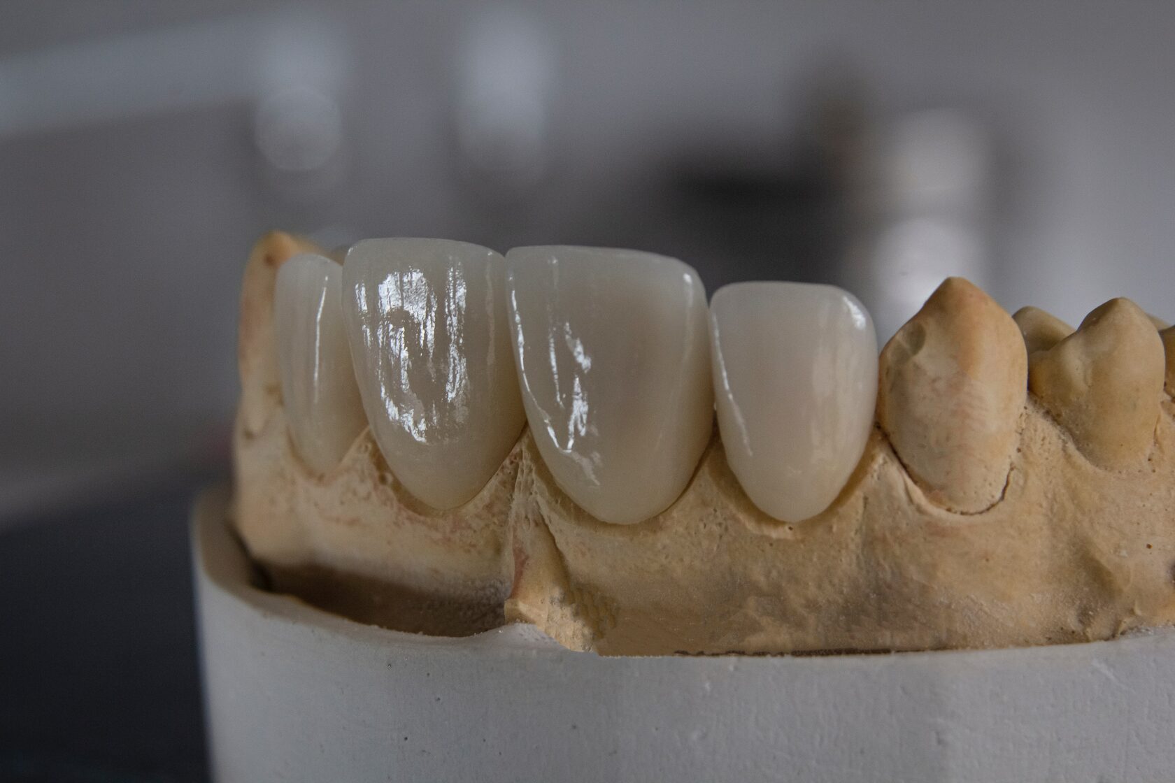 фото протезирования передних зубов