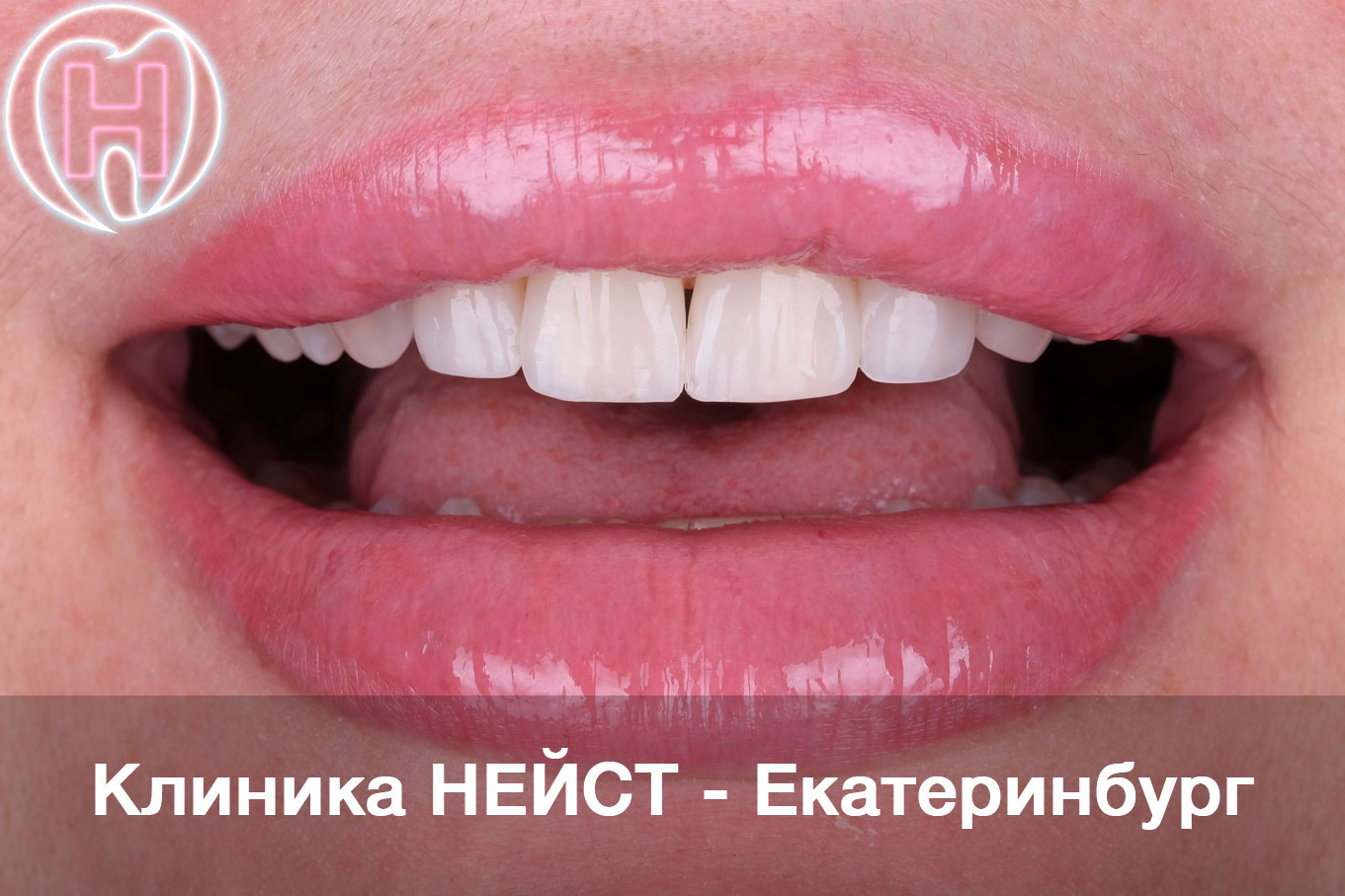 Авторские композитные виниры в Екатеринбурге, цвет А1