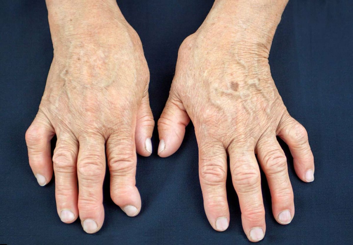 Деформация суставов пальцев кистей и стоп