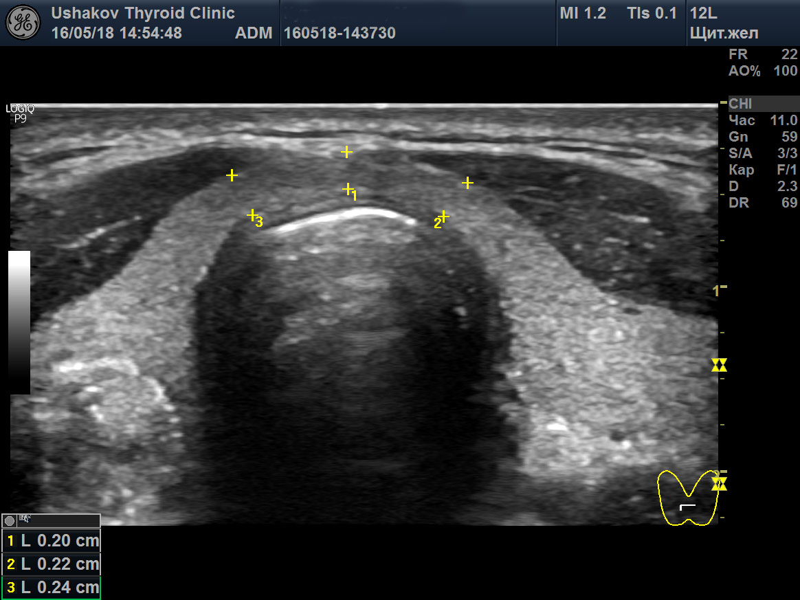 Фото узи щитовидной железы с узлом