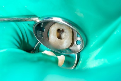 Root canal treatment in San Bernardino at Vernon Dental Specialty