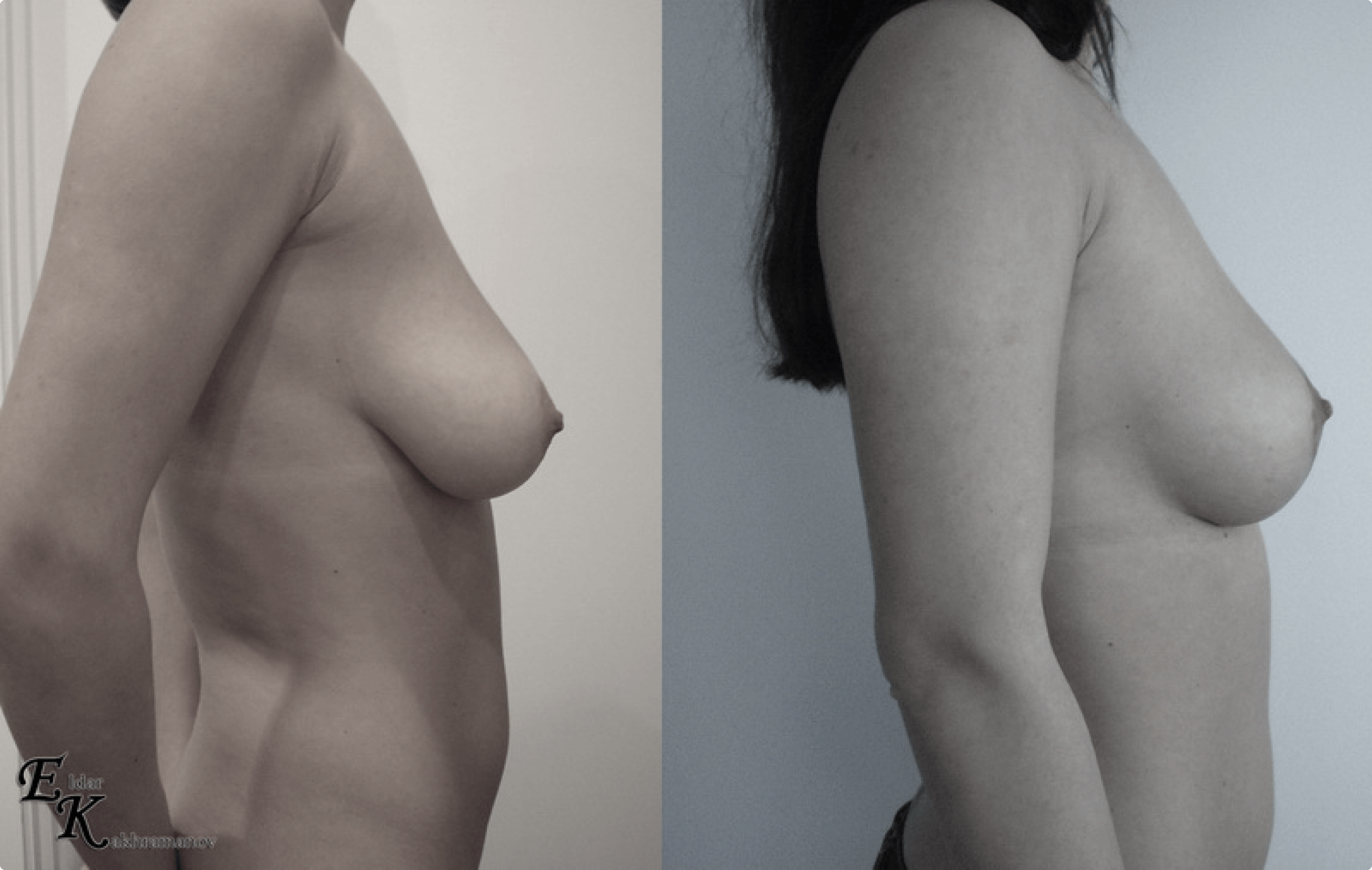 подтяжка груди у женщин фото 28