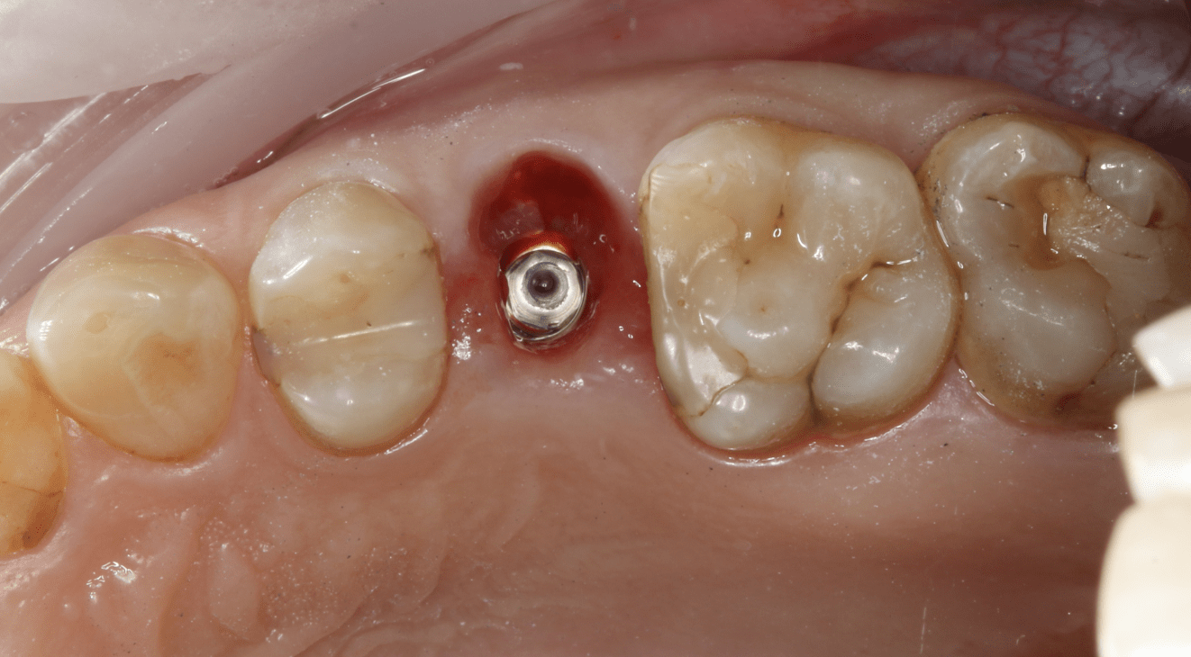 Имплантация зубов в стоматологической клинике Пробел у метро Динамо