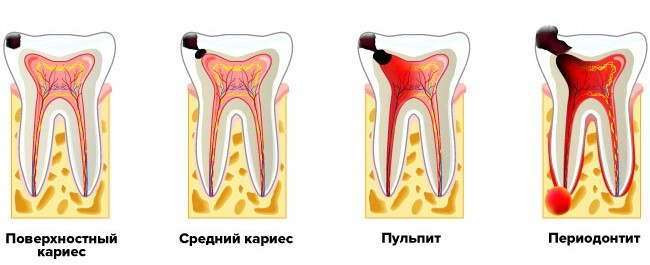 Чувствительные зубы реагируют на холод: что нужно знать