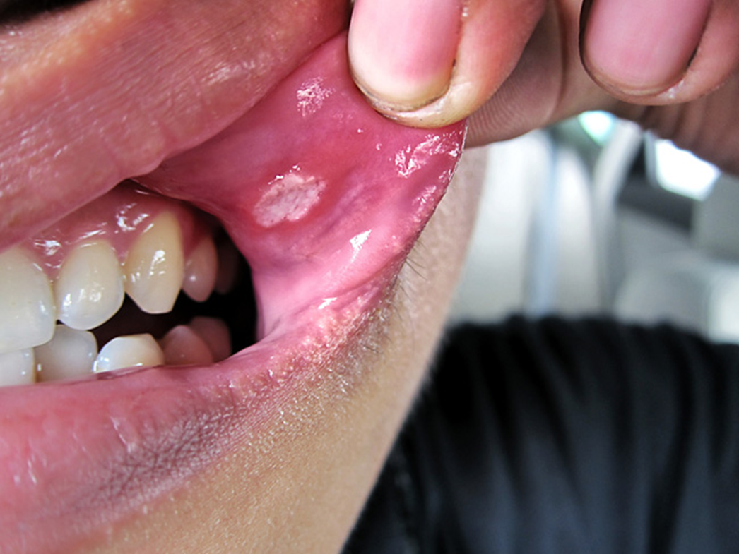 Основные разновидности лейкоплакии полости рта