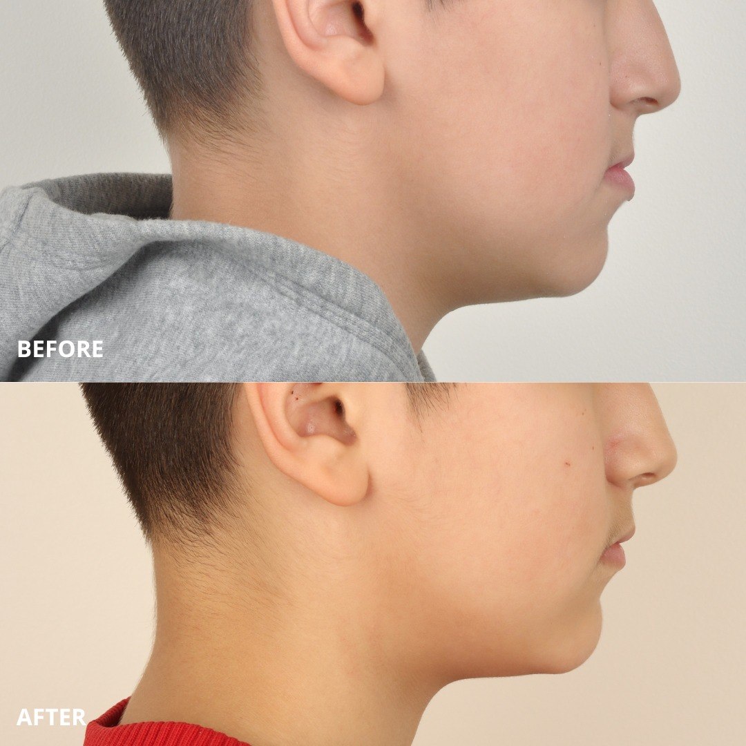 Stage photo documenting occlusal changes during ongoing growth monitoring — photo 5 of 7
