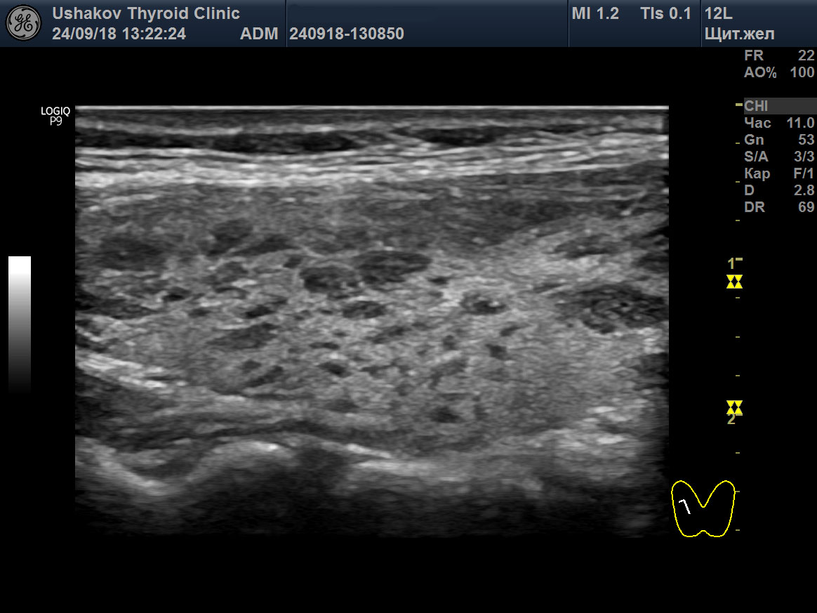 Диффузное аутоиммунное изменение щитовидной железы. Аденома щитовидной железы на УЗИ. Диффузные изменения щитовидной железы УЗИ. Аутоиммунный тиреоидит УЗИ картина. Аутоиммунный тиреоидит на УЗИ.