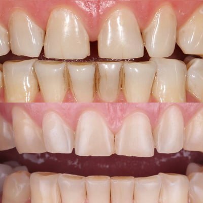 Подготовка к установке виниров