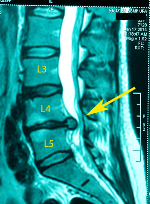 Грыжа диска l4 l5 фото