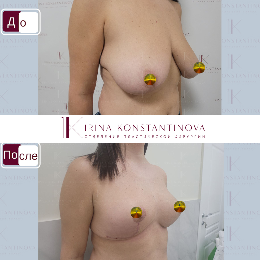 операция по уменьшения размера груди фото 37
