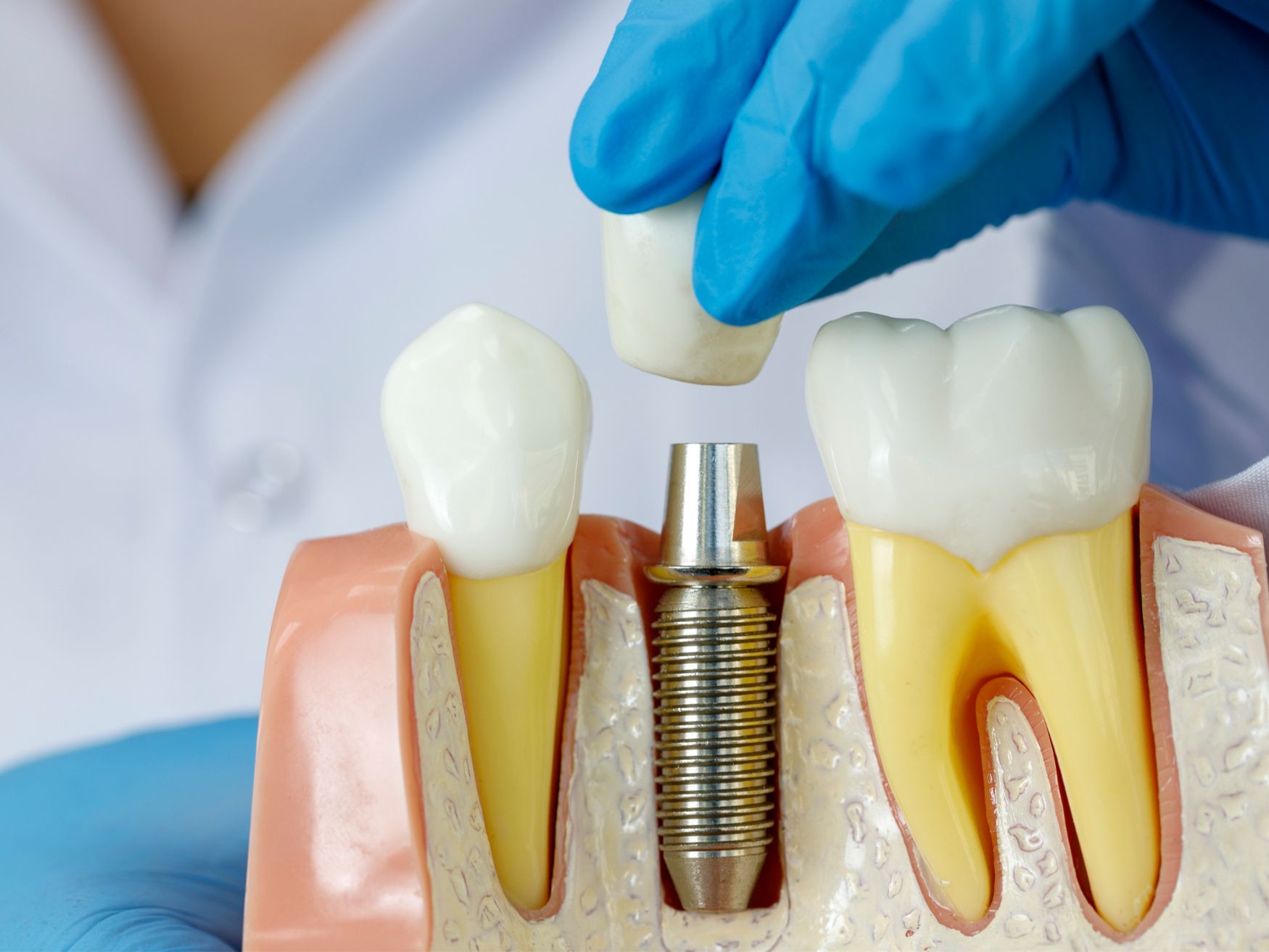 «Один зуб обошелся в 147 000 ₽»: сколько стоит имплантация зубов в разных городах