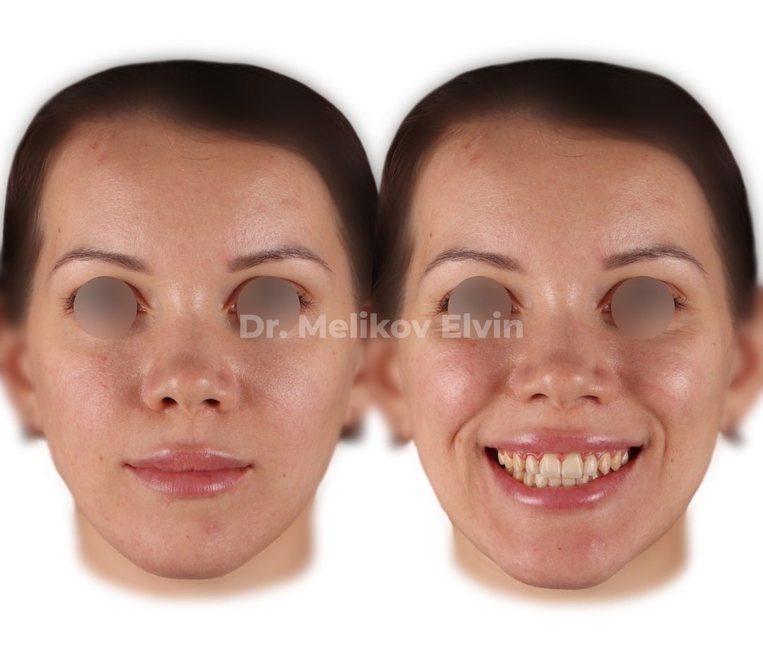 Фотографии после ортогнатической операции.