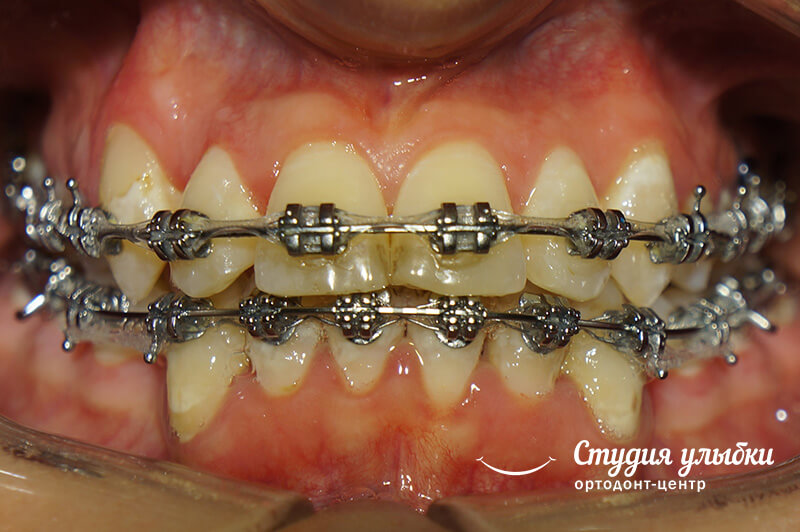 Брекеты екатеринбург. Сколько болят зубы после подтяжки брекетов. Почему болят зубы после смены дуги брекеты.
