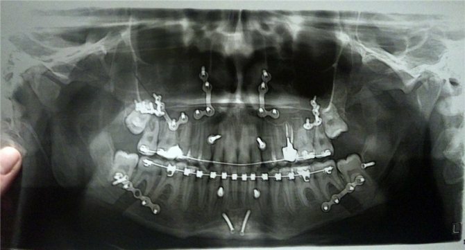 Можно ли с зубным имплантом делать мрт. Магнитно резонансная томография челюсти. Кт верхней челюсти снимки.
