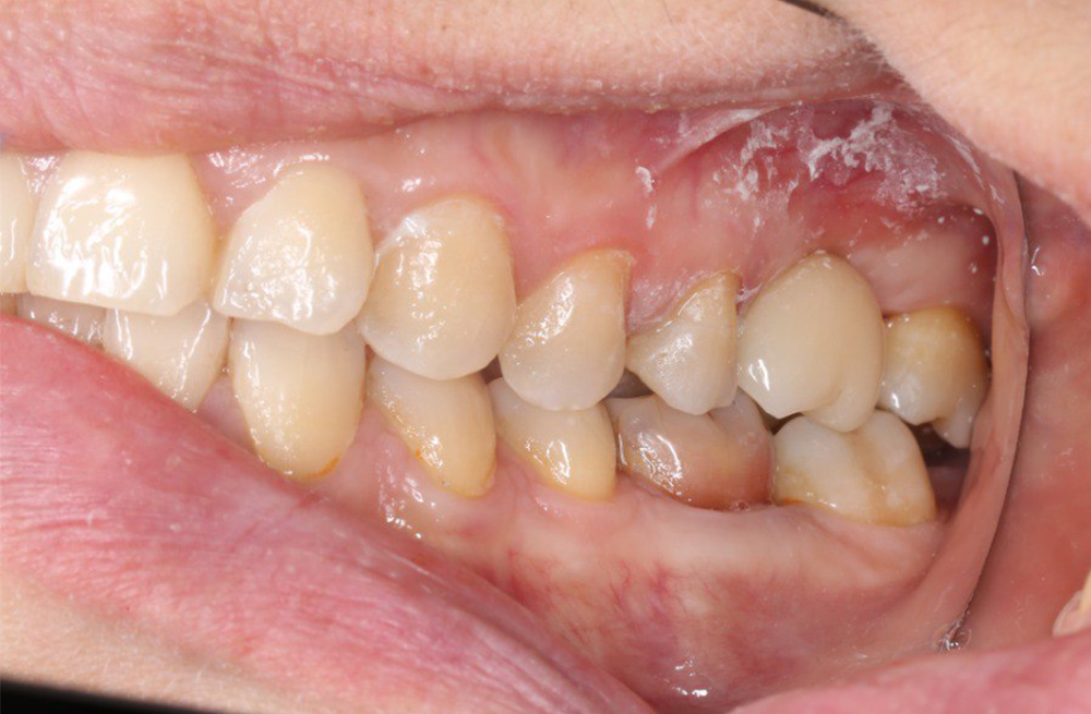 Эффективное протезирование зуба с одномоментной имплантацией и циркониевой коронкой