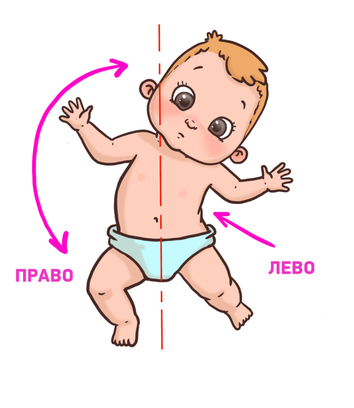 Гипертонус мышц новорожденных