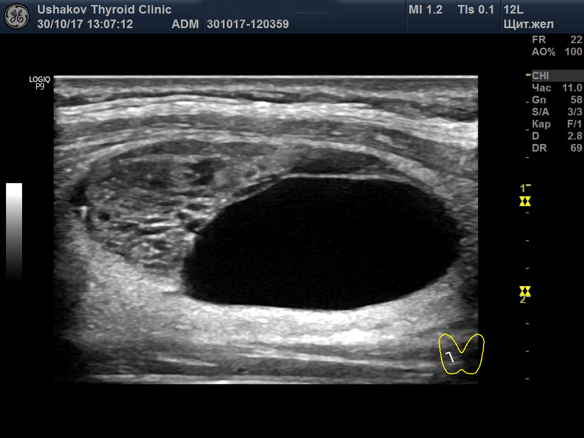 Фото узи щитовидной железы с узлом