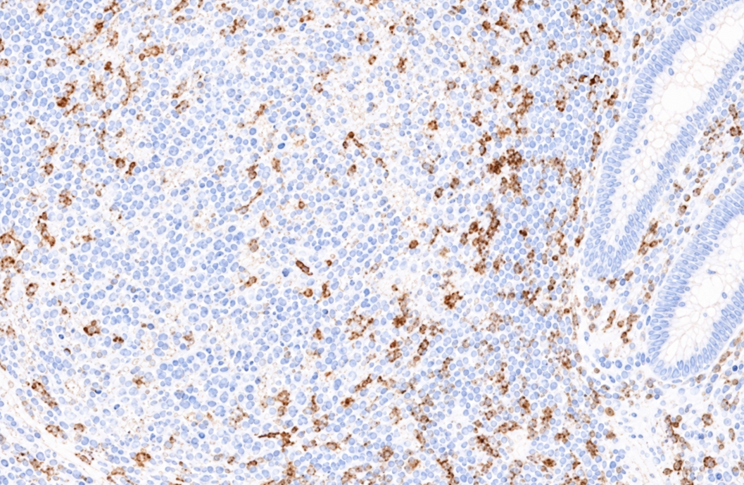 Недостаточное окрашивание CD4 в миндалине