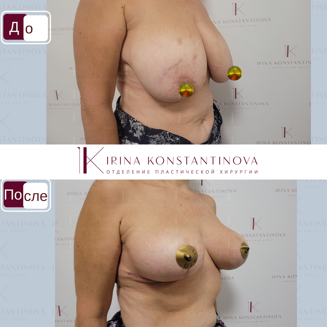 уменьшение груди у женщин фото 77