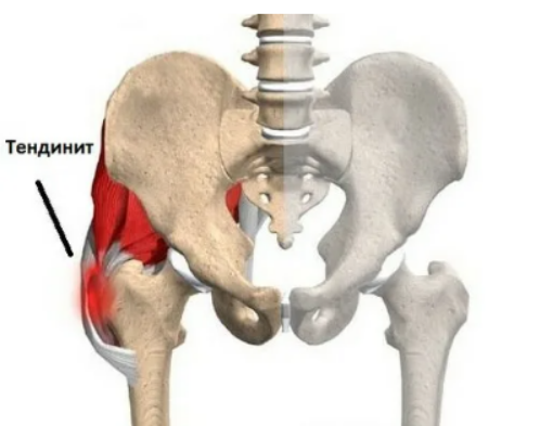 Тендинит таза
