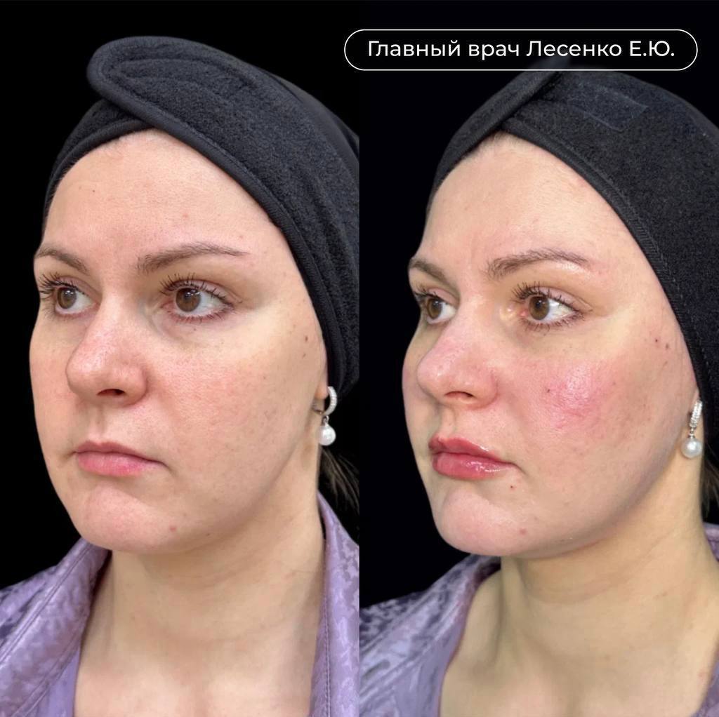 Результат процедуры криолиполиза и процедур Icoone Laser