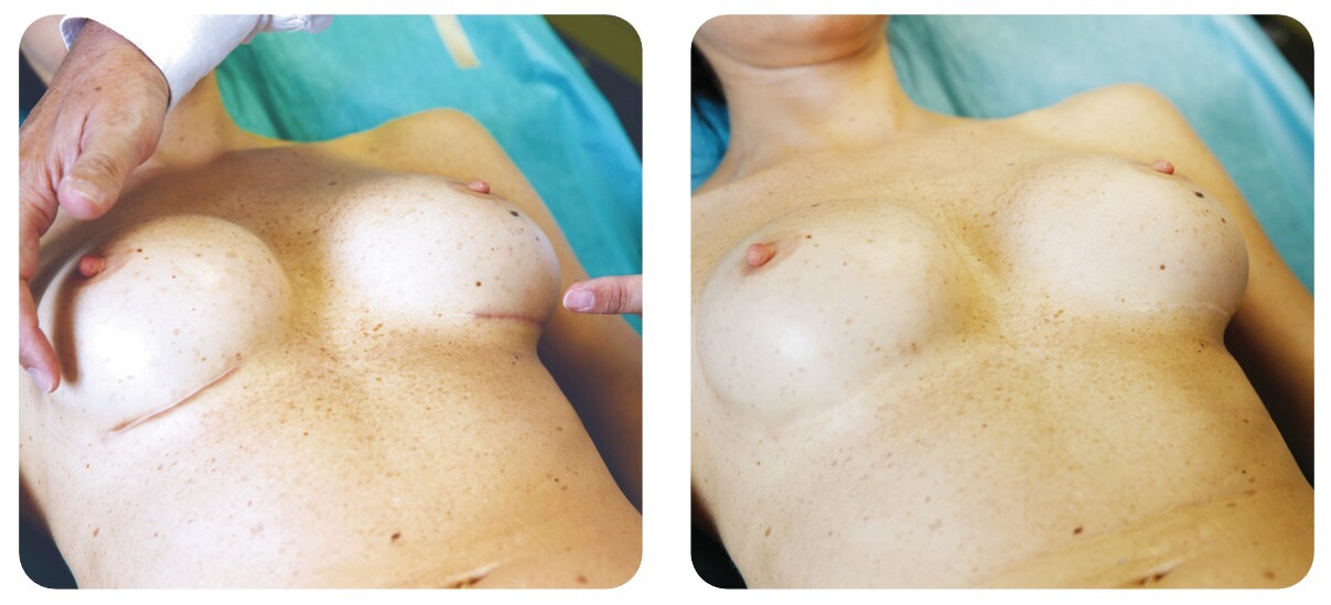 пластырь для груди поле операции