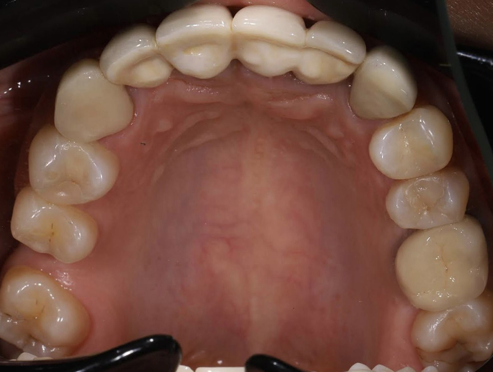 Подготовка к имплантации с помощью брекетов Experience