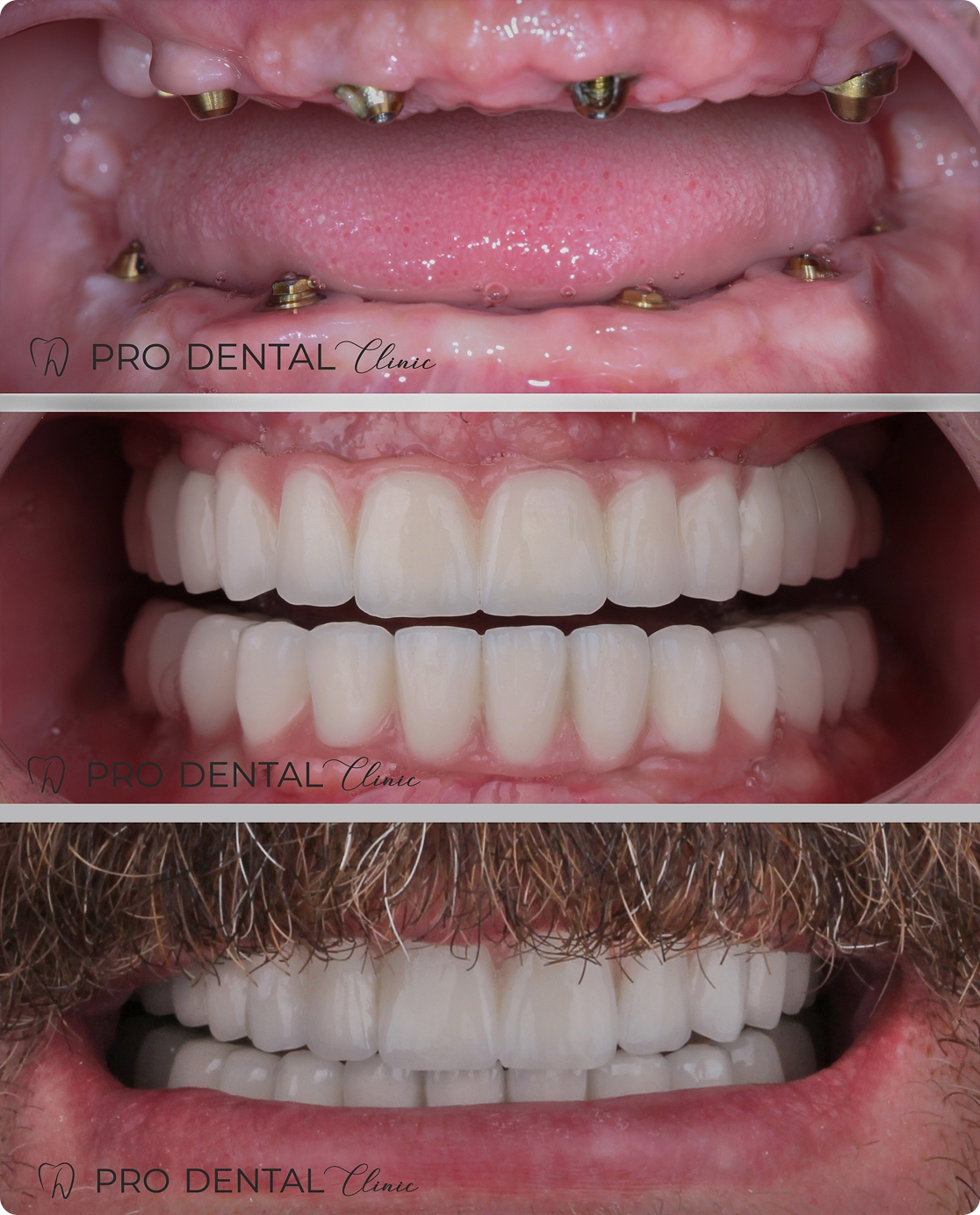 Опубликованный кейс Dental Clinic: этапы восстановления зубов с помощью Всё на 4-х