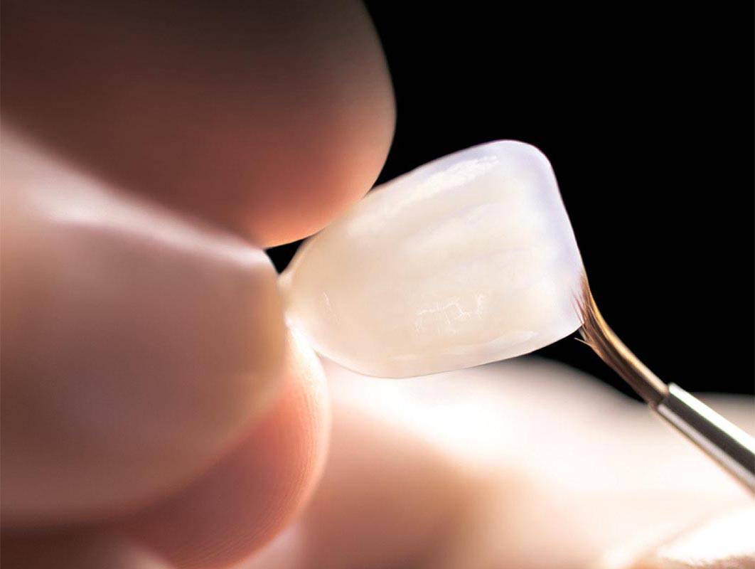 Виниры на зубы в Москве. Цена винира за 1 зуб