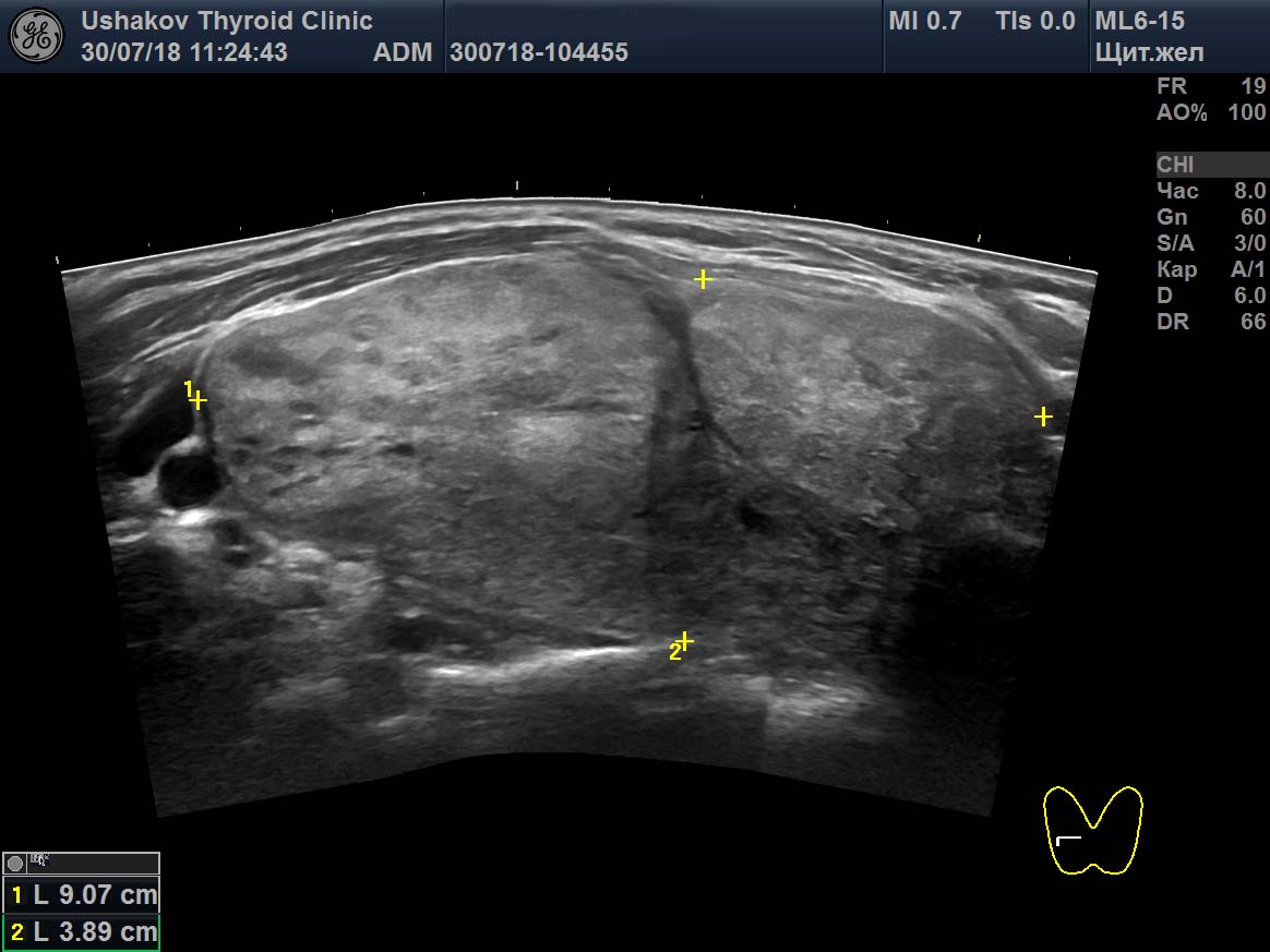 узи мягких тканей протокол узи. узи мягких тканей спины. узи картина гематомы мышцы. опухоли мышечной ткани на узи. узи мягких тканей.