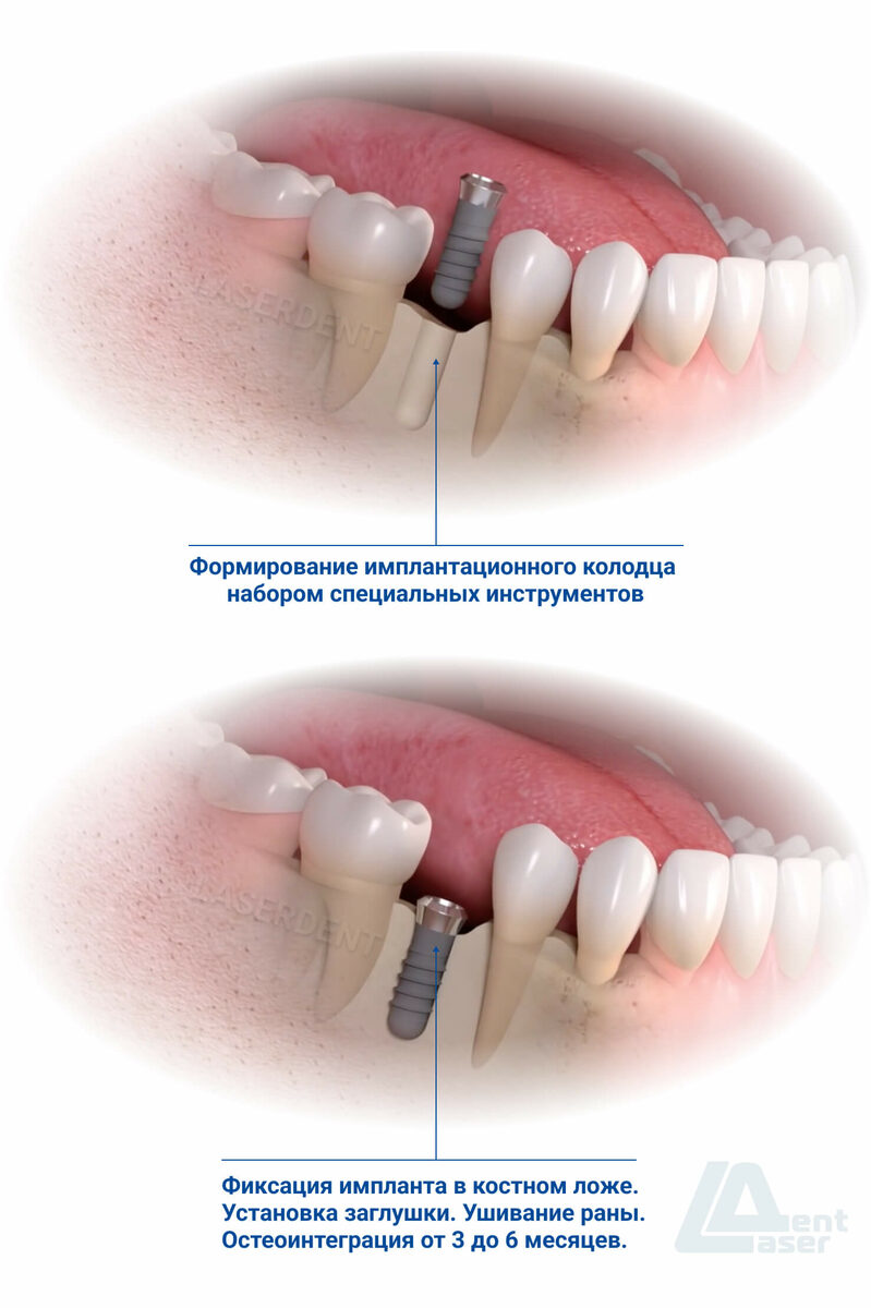 Имплантация зубов в стоматологии Лазердент Хабаровск