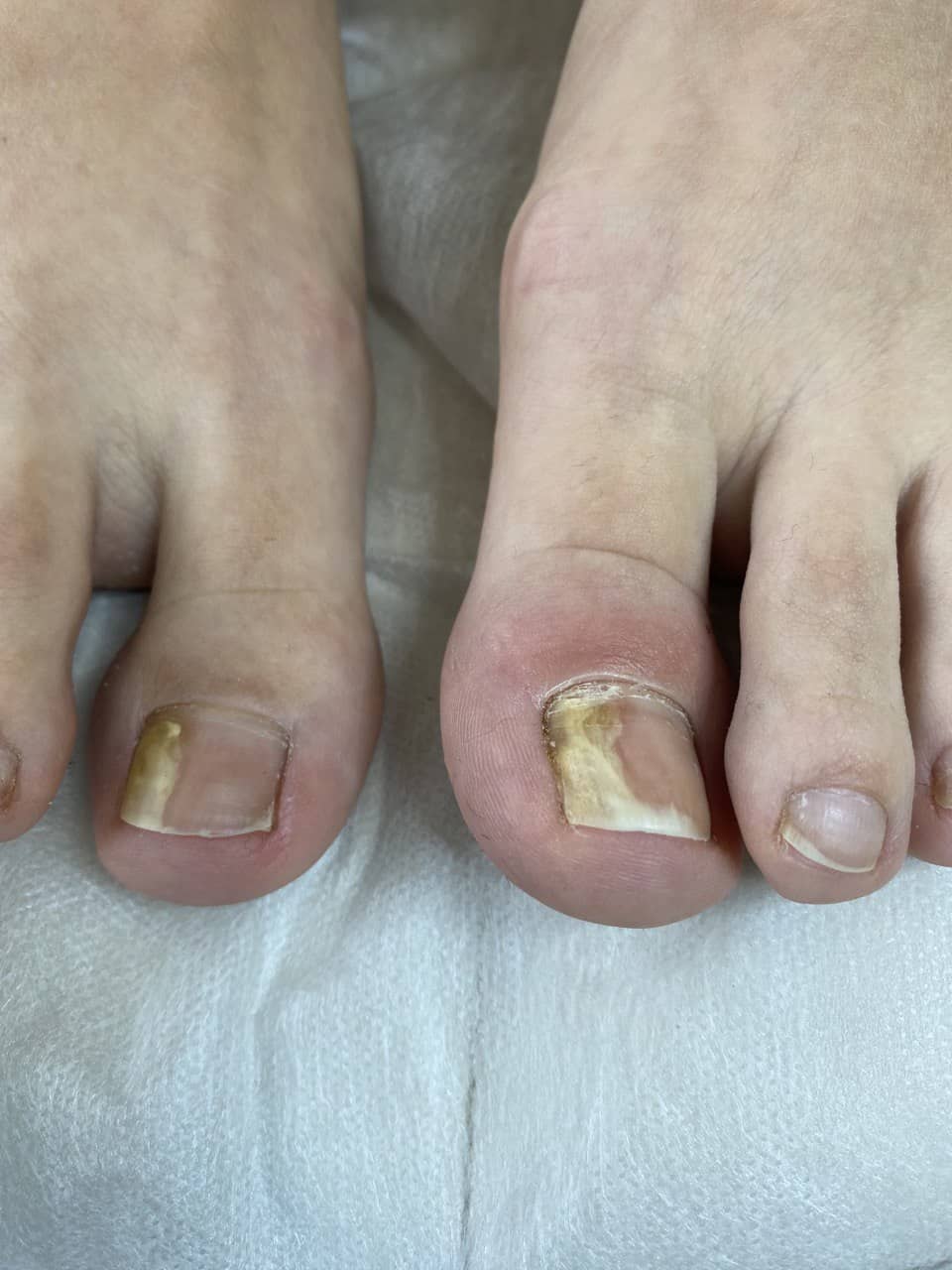 онихолизис +на ногах