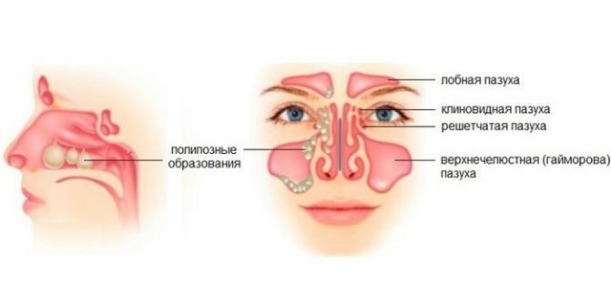 Как многолетний насморк закончился операцией и сколько это стоило