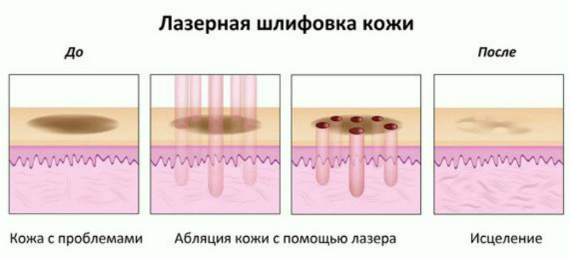 Глубокая лазерная шлифовка
