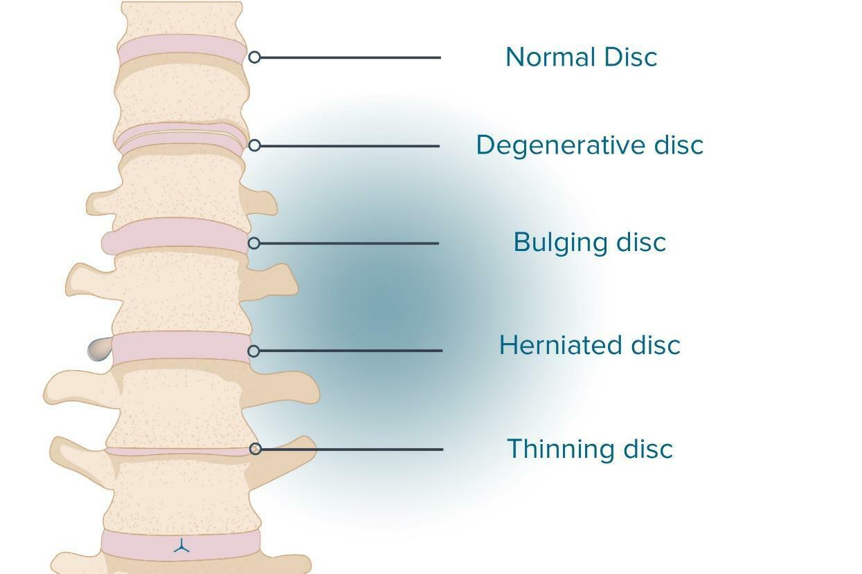 Herniated Disc: Symptoms, Causes & Treatment Options