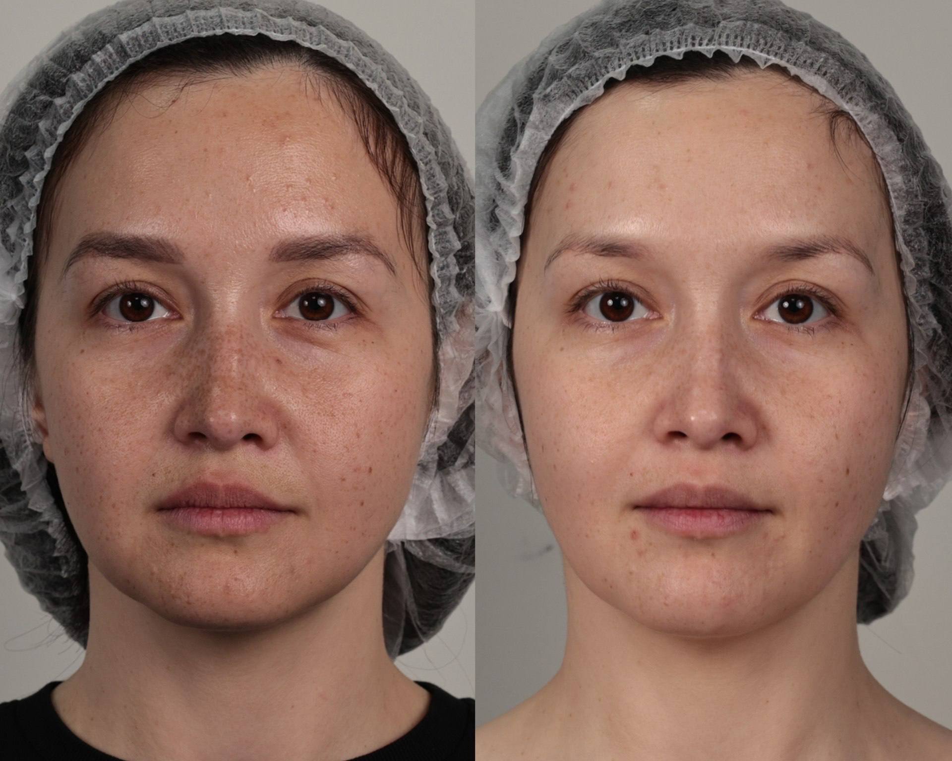 Лицо до и после SkinHale