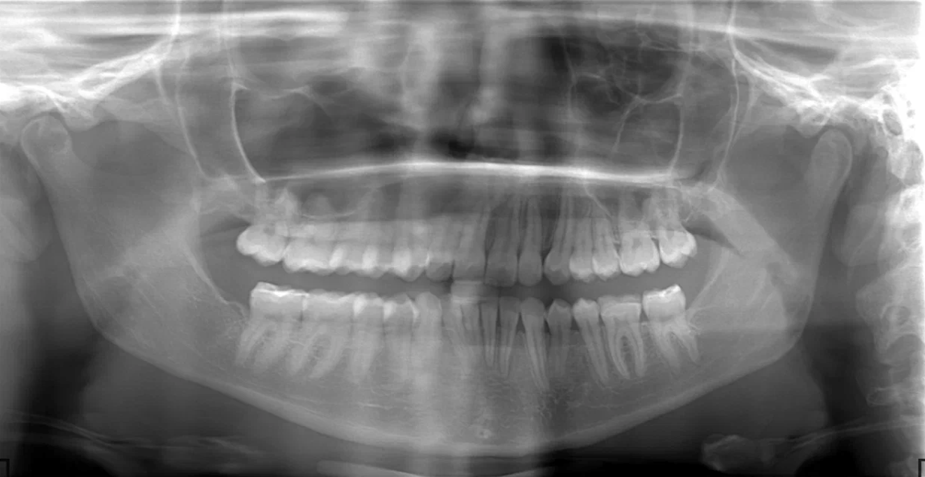 панорамный снимок зубов сделать в Москве в клинике Пробел