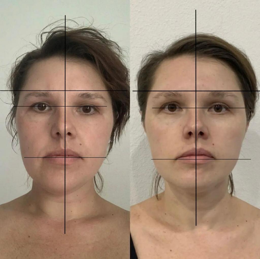Асимметрия лица. Симметричность лица и шеи. Кости лица и красота. До и после апгрейда лица.