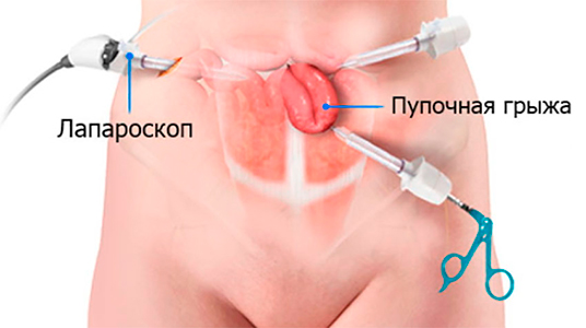 Лапароскопическая герниопластика