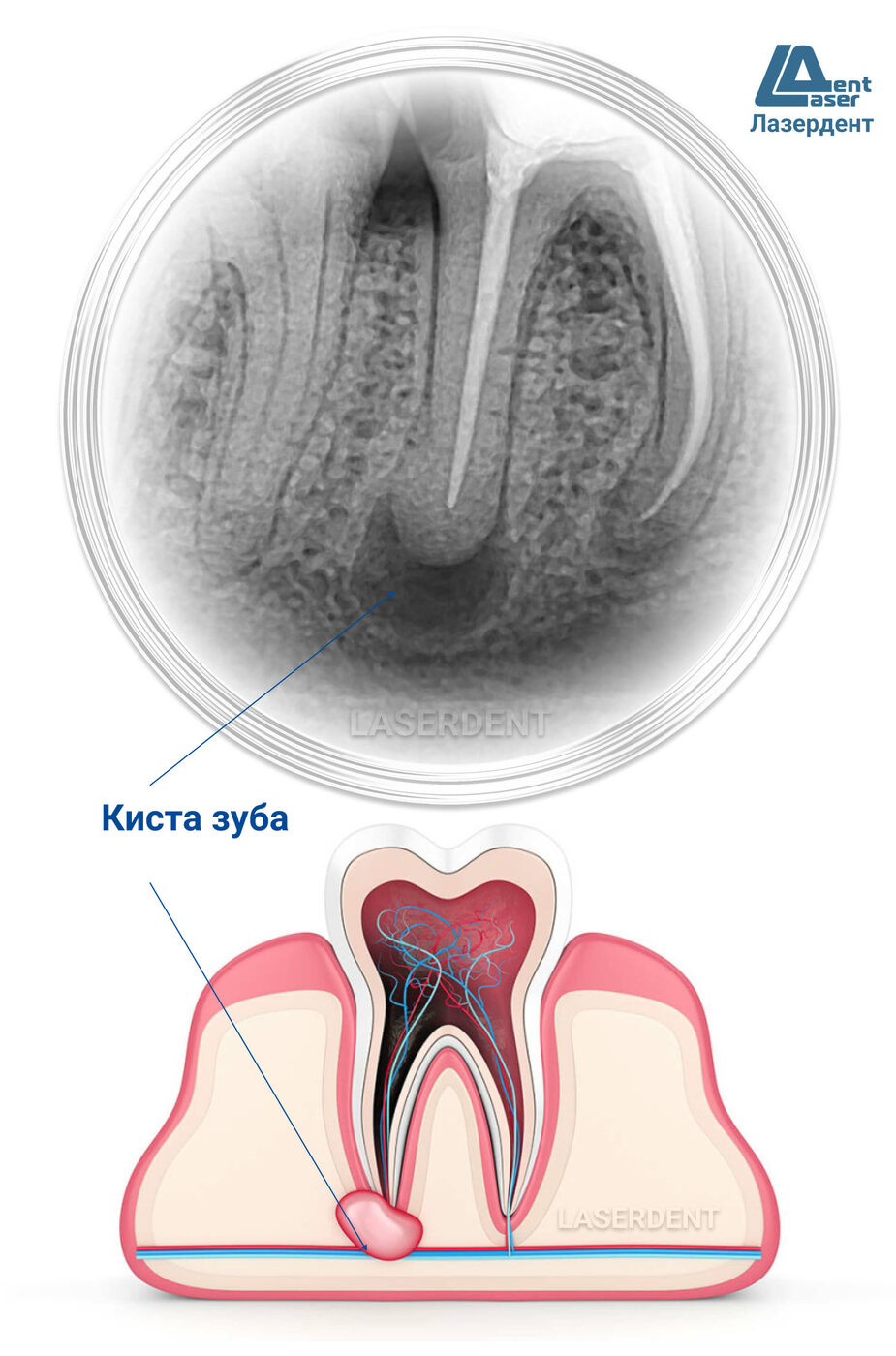Киста зуба: лечение народными средствами в домашних условиях