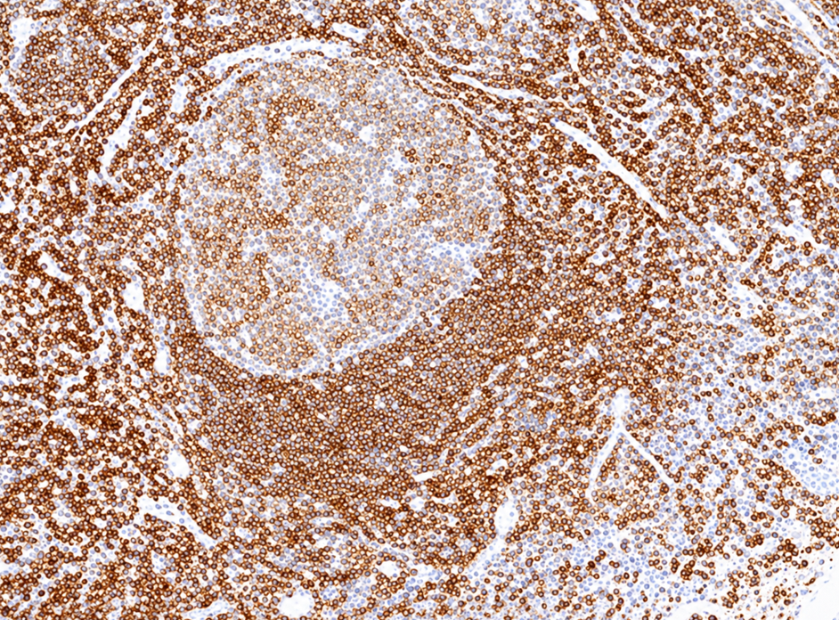 Недостаточное окрашивание CD45 в миндалине