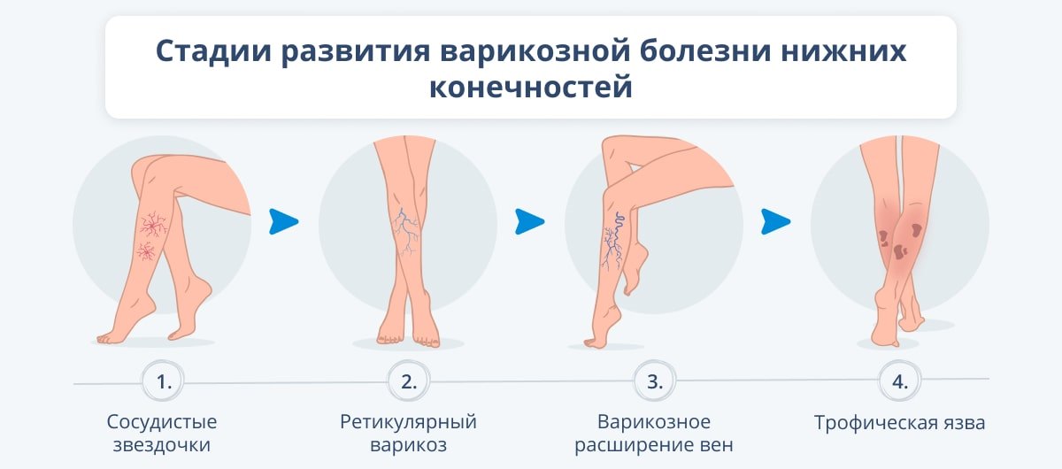 Лечение трофических язв на ногах при варикозе