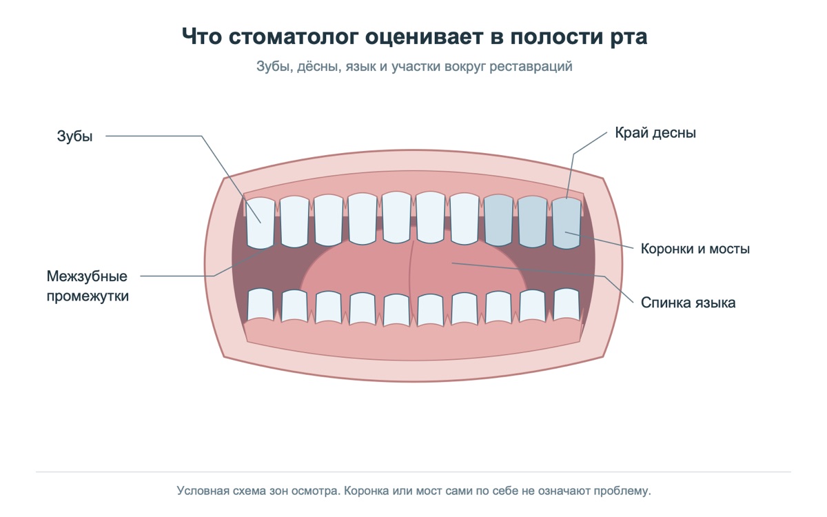 Схема зон полости рта, которые врач оценивает при жалобе на запах изо рта