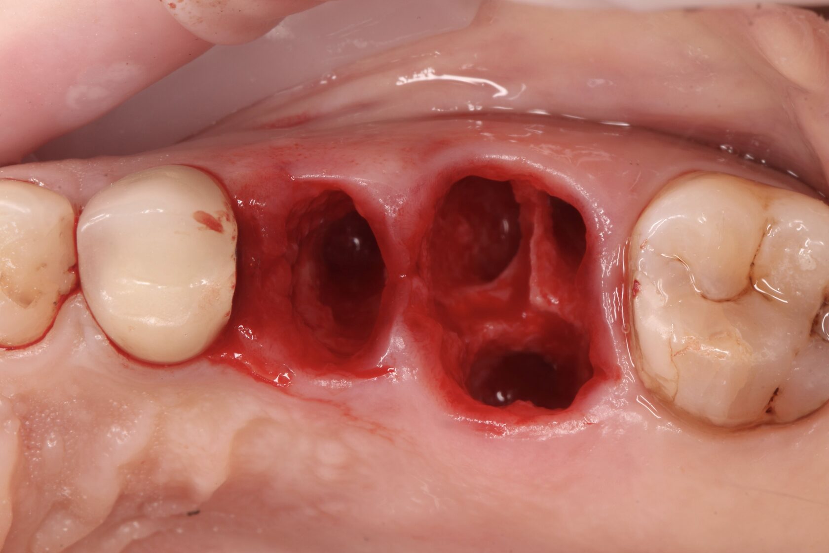 Удаление зубов, планируется установка имплантов Эниван