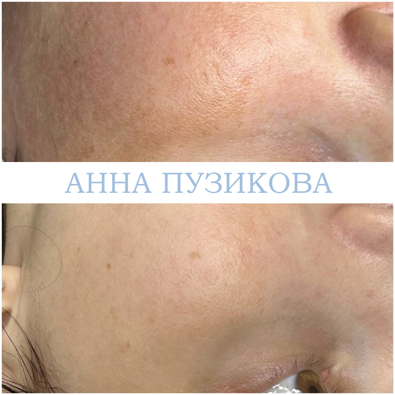 Результат удаления пигментных пятен после курса фототерапии ClearLight IPL — врач-косметолог Пузикова Анна Анатольевна, Санкт-Петербург