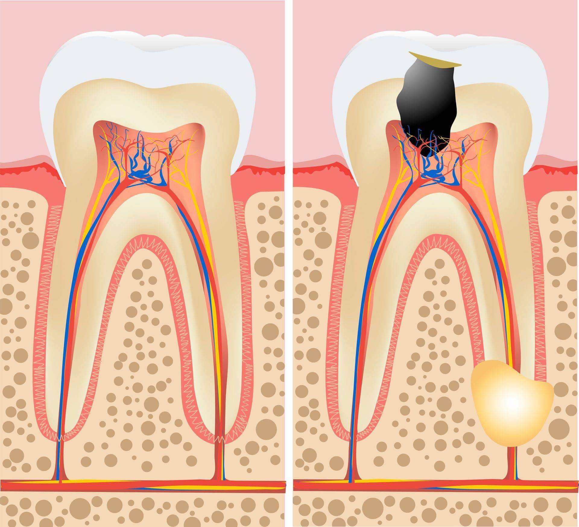 зубной нерв строение зуба фото