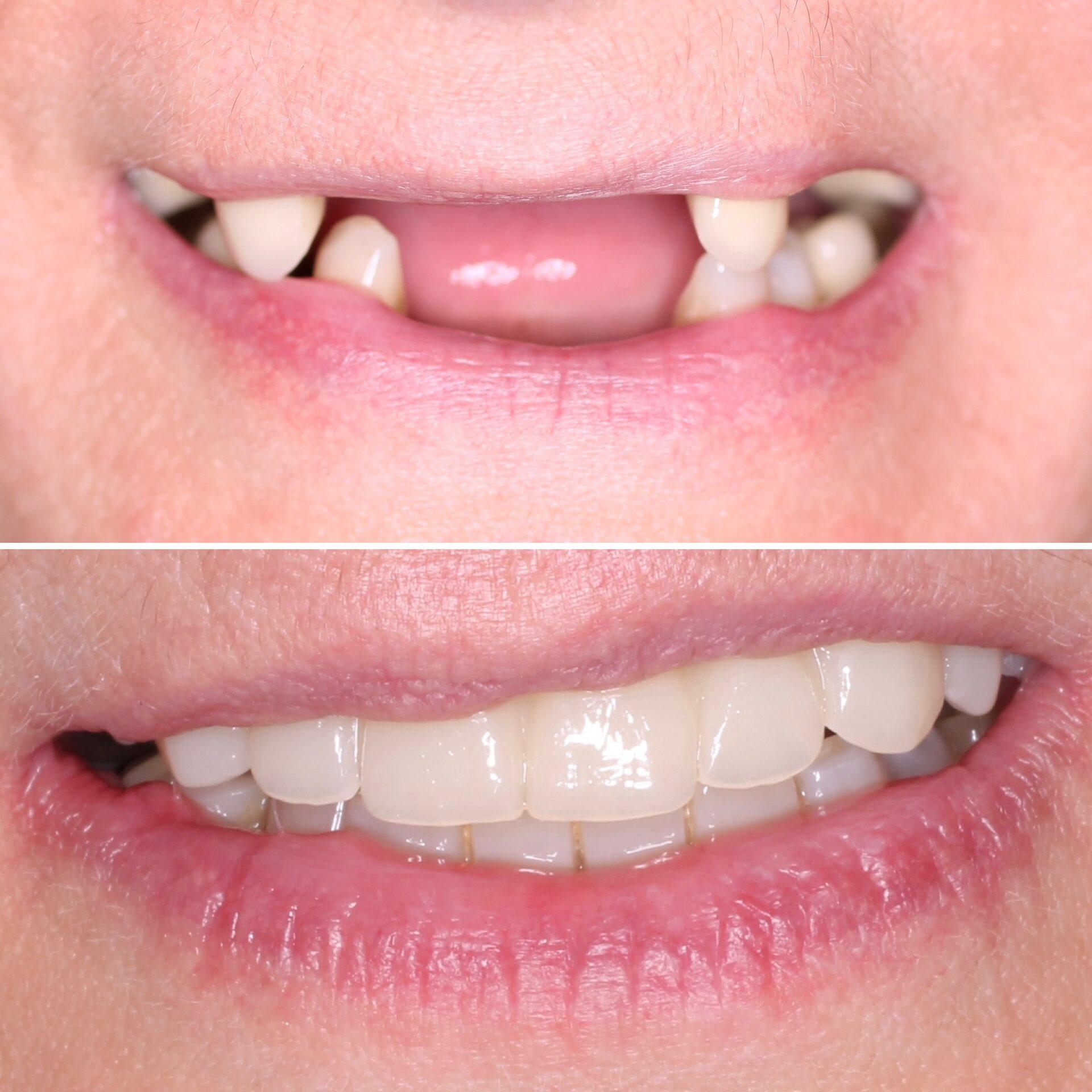 имплантация зубов чебоксары,имплантация зубов йошкар-ола,тотальная реабилитация на 6 имплантатах,протез несьемный в чебоксарах