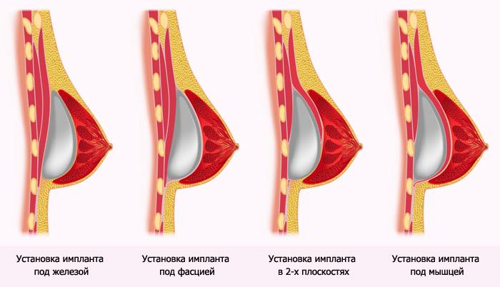 Увеличение груди: методы установки имплантов. Киев.